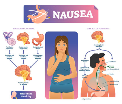 Nausea vector illustration. Labeled medical vomiting explanation scheme.