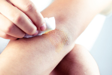 Wounds in the arms of men caused by sport.