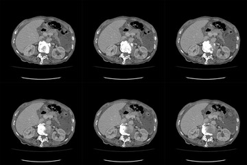 Computed tomography CT whole abdomen in Axial. Part eighteen