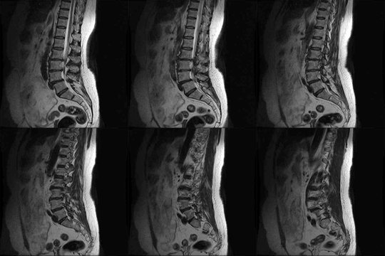 CT Computed tomography scans of human spine on a ultrasound computer monitor. Part two
