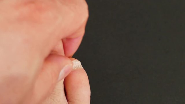 athlete's foot, ringworm between the toes, Fungal disease between toes,