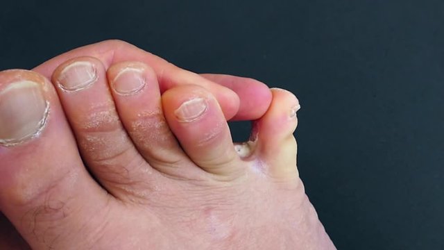 Fungal disease between toes, a human foot with foot care, neglected and fungal disease,