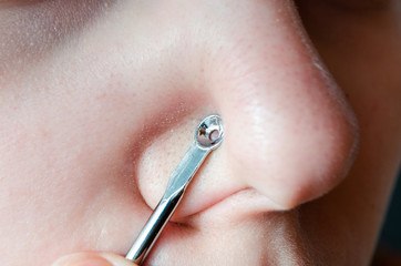  A tool for removing black spots and acne on the skin. Nose with large pores and black dots. Facial...