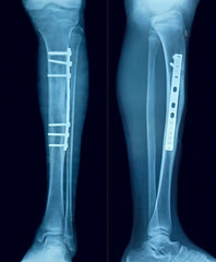 Film x-ray show fracture shaft of tibia and fibular insert plate and screw for fix leg’s bone