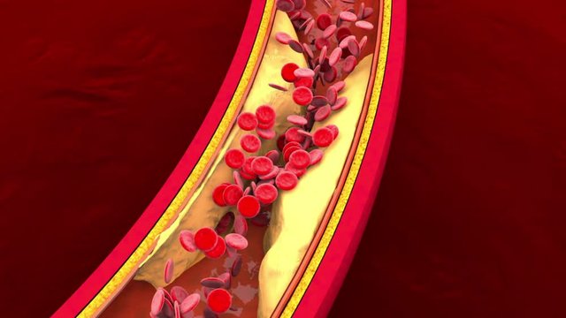 3D rendered Animation of Hemoglobin cells flowing through a clogged Artery developing the illness Arteriosclerosis.