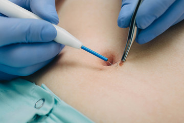 procedure removing mole. radio wave electrocoagulation method