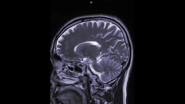 MRI of the brain in sagittal plane with gadolinium contrast media. magnetic resonance imaging of the brain.