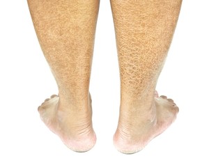 Dry and cracked skin ,   Ichthyosis vulgaris. 