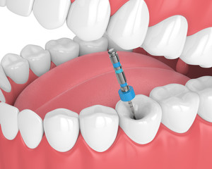 3d render of tooth with endodontic file in jaw