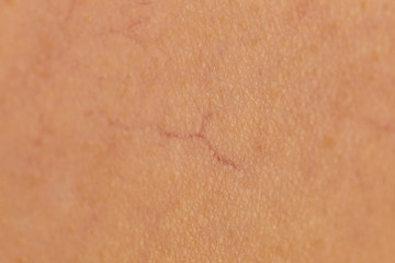 Ski with dilated capillaries ad red spots