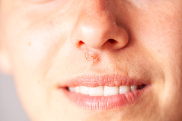 Obraz premium herpes under the nose