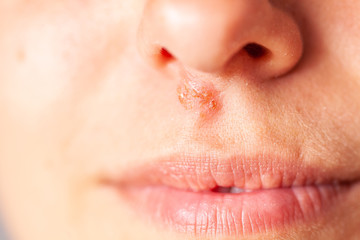 Obraz premium herpes under the nose