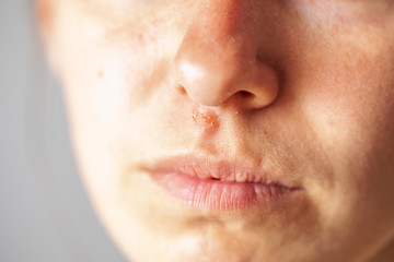 Fototapeta premium herpes under the nose