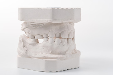Dental casting gypsum model of human jaws. Crooked teeth and distal bite. Shots were made before...