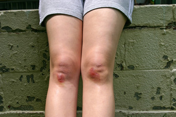 Childs Skinned Knees in Summer