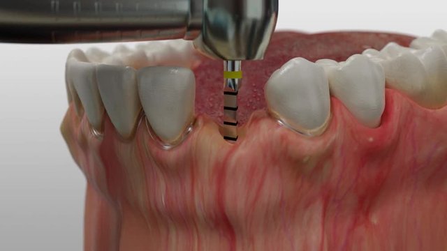 Insertion eines Keramik-Implantats im Unterkiefer mit einsetzen der Zahnkrone