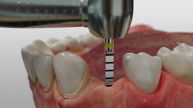 Insertion eines zweiteiligen Titan-Implantats im Unterkiefer mit Einsetzen der Zahnkrone
