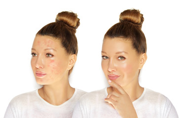 Post-Acne Marks /Treating Acne Scars.Acne Scar Removal