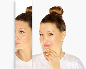 Post-Acne Marks /Treating Acne Scars.Acne Scar Removal