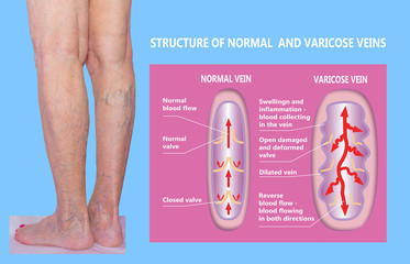 Varicose veins on a female senior legs. The structure of normal and varicose veins.