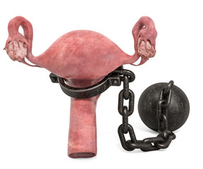 Uterus disease concept. Human uterus with shackle. 3D rendering