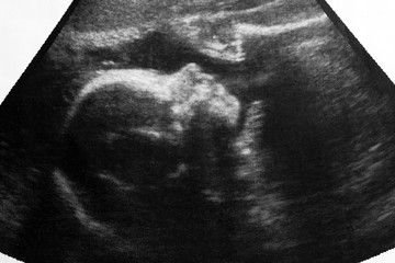 Ultrasound photo of unborn baby in mother's womb, closeup view - obrazy, fototapety, plakaty