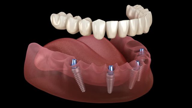 Mandibular prosthesis All on 4 system supported by implants. Medically accurate 3D animation of human teeth and dentures concept