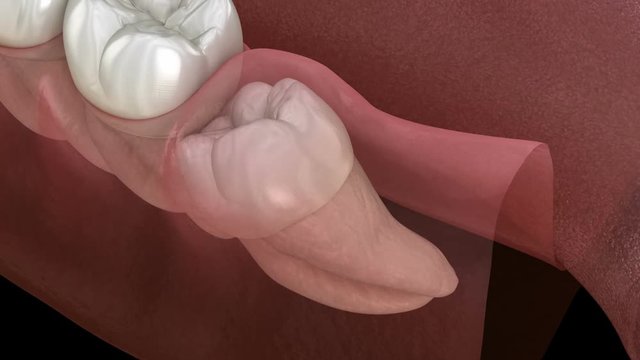 Healthy teeth and wisdom tooth with mesial impaction . Medically accurate tooth 3D animation