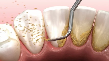 Oral hygiene: Ultrasonic teeth cleaning machine removing calculus and plaque. Medically accurate 3D animation of human teeth treatment