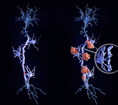 Multiple sclerosis (MS): heatlhy neuron with intact myelin sheaths (left), neuron affected by MS (right)