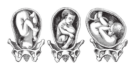 Positions child in womb / vintage illustration from Die Frau als hausarztin 1911