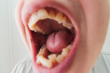 European male open mouth crooked yellow teeth dry lips