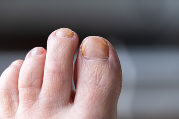 Fungal nail infection on human foot.