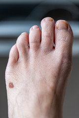 Human foot with toenail infection and mole.