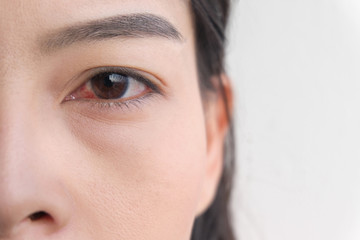 red eye. conjunctivitis or irritation of sensitive eyes.