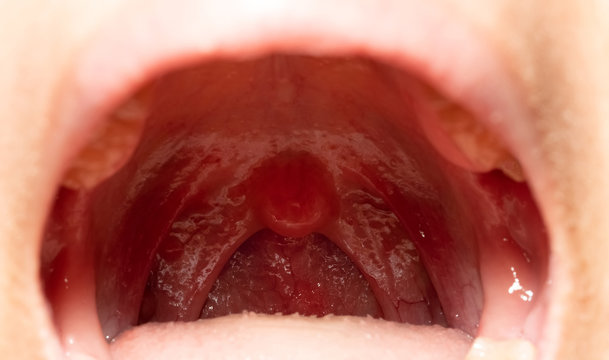 Uvula lumps papilloma, Papiloma uvula tratamiento, - Uvula lumps papilloma, Papiloma uvulae