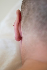 drop of blood on the ear after taking out acupuncture needle 