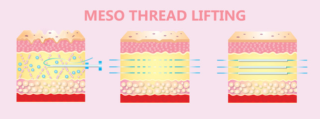 illustration of meso threads lifting