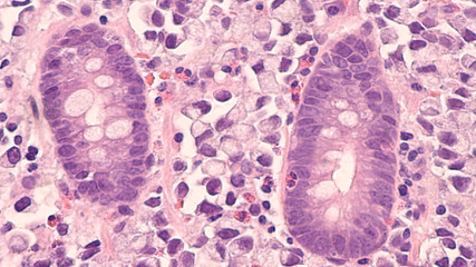 Microscopic image of a stomach cancer (poorly differentiated gastric adenocarcinoma, mucinous...