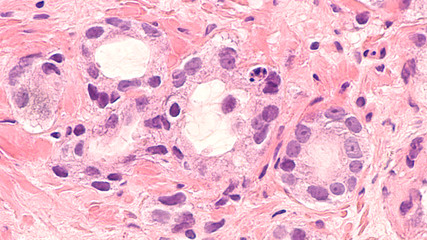 Cancer of the prostate: microscopic image of prostatic adenocarcinoma, with small infiltrating...