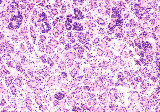 Microscopic image of a pituitary adenoma, a benign tumor of the pituitary, a hormone producing gland at the base of the brain. 