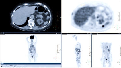 PET Scan image of whole body Comparison Axial , Coronal and sagittal plane in patient spleen cancer recurrence treatment by PET CT Scanner - obrazy, fototapety, plakaty