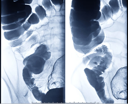 barium enema image or x-ray image of large intestine or colon showing anatomical of large intestine and appendix for diagnosis Colorectal cancer.