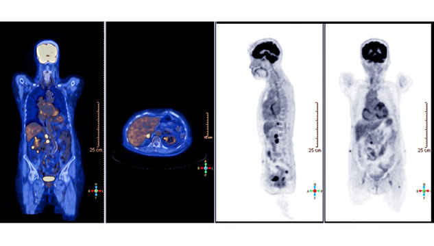 PET Scan image of whole body Comparison Axial , Coronal and sagittal plane  in patient hepatic cell carcinoma recurrence treatment by PET CT Scanner. rectangle HD size.