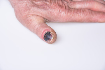 Black thumb finger nail from injury