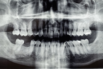 Panoramic dental X-Ray, one back tooth hole