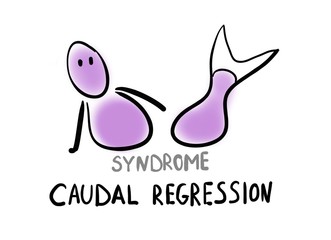 Caudal regression syndrome