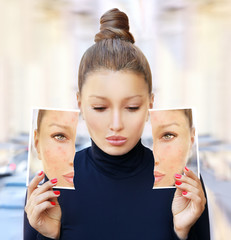 Post-Acne Marks /Treating Acne Scars.Acne Scar Removal