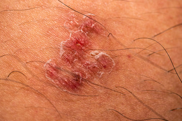 skin rash and blisters on body (Shingles on men herpes zoster)