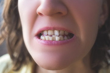 Photo of crooked woman teeth
